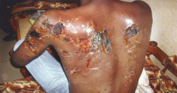 Dos brûlé d'une victime des FRCI